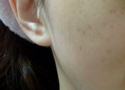 醫美｜沒麻藥就直接上了．淨膚雷射+美白針 ♥ 尼斯診所 甩掉小曬斑