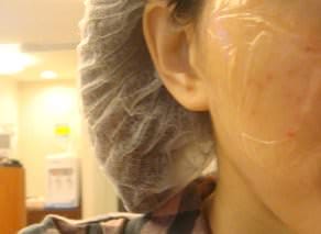 醫美｜沒麻藥就直接上了．淨膚雷射+美白針 ♥ 尼斯診所 甩掉小曬斑